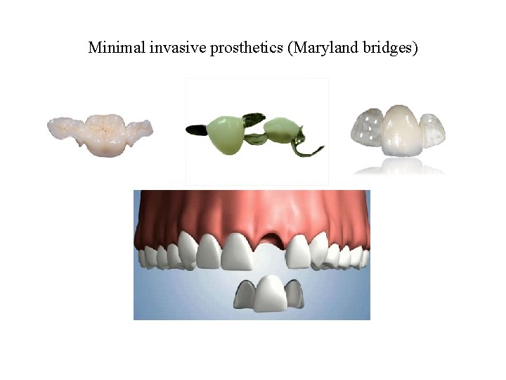 Minimal invasive prosthetics (Maryland bridges) 