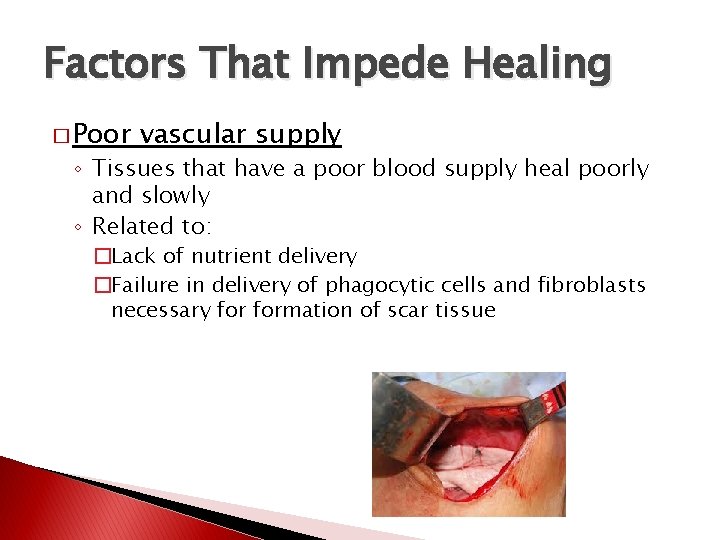 Factors That Impede Healing � Poor vascular supply ◦ Tissues that have a poor