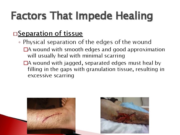 Factors That Impede Healing � Separation of tissue ◦ Physical separation of the edges