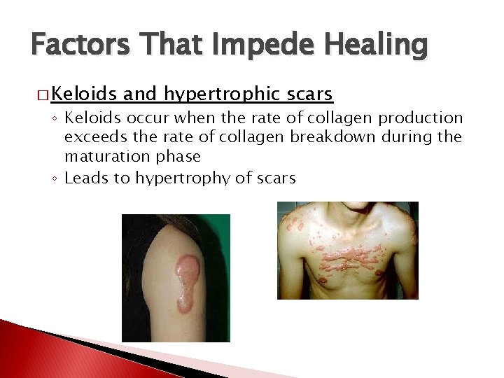 Factors That Impede Healing � Keloids and hypertrophic scars ◦ Keloids occur when the