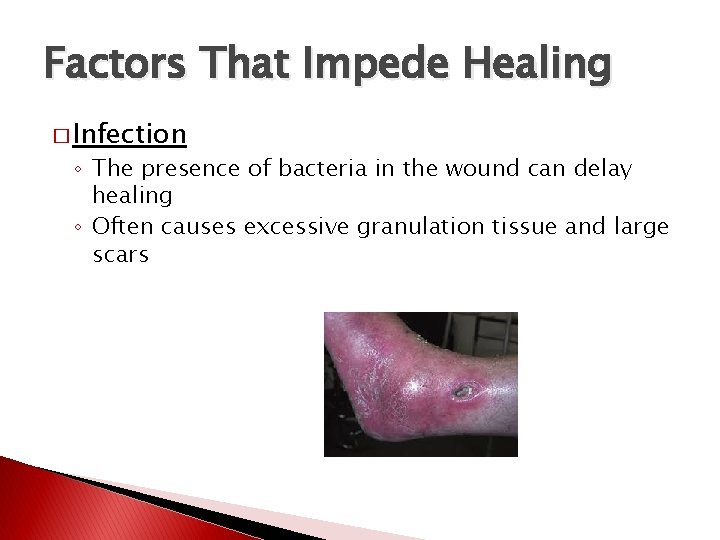 Factors That Impede Healing � Infection ◦ The presence of bacteria in the wound