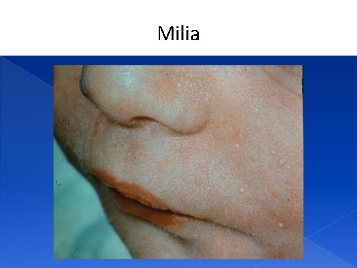 Milia 