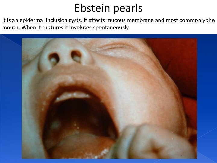 Ebstein pearls It is an epidermal inclusion cysts, it affects mucous membrane and most