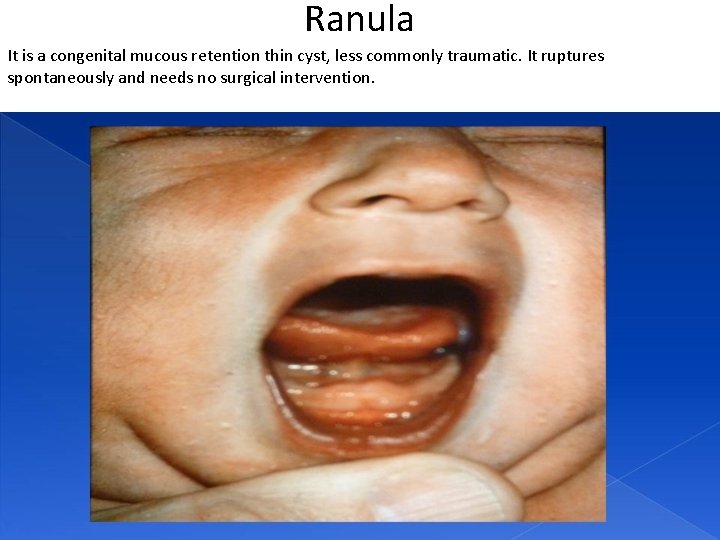 Ranula It is a congenital mucous retention thin cyst, less commonly traumatic. It ruptures