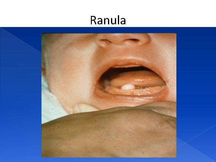 Ranula 