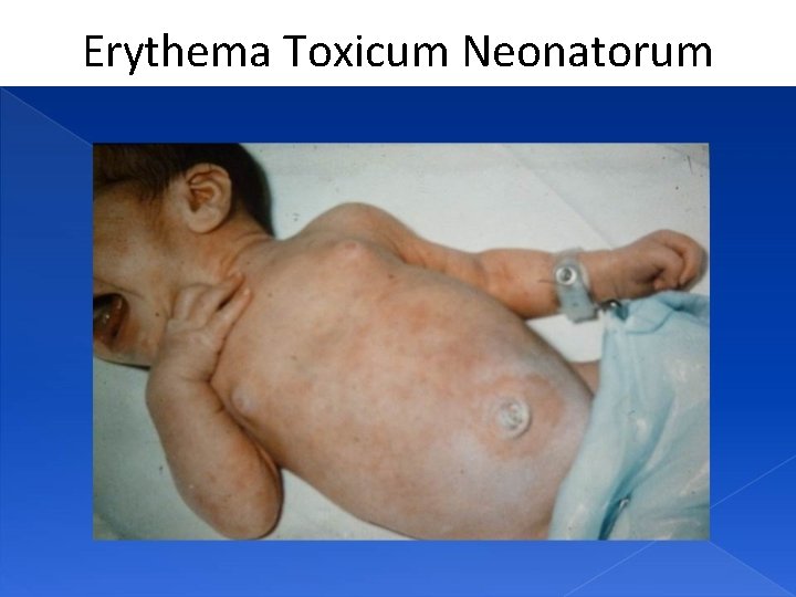 Erythema Toxicum Neonatorum 