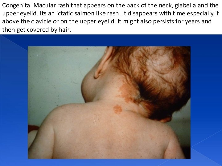 Congenital Macular rash that appears on the back of the neck, glabella and the