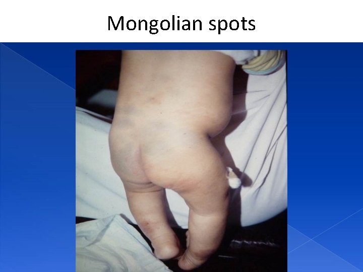 Mongolian spots 