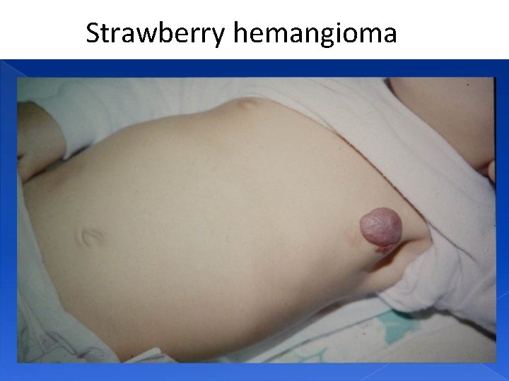 Strawberry hemangioma 