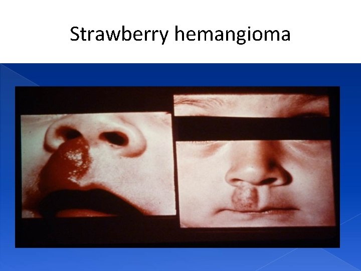 Strawberry hemangioma 