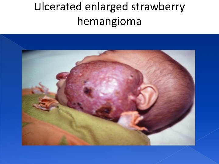 Ulcerated enlarged strawberry hemangioma 