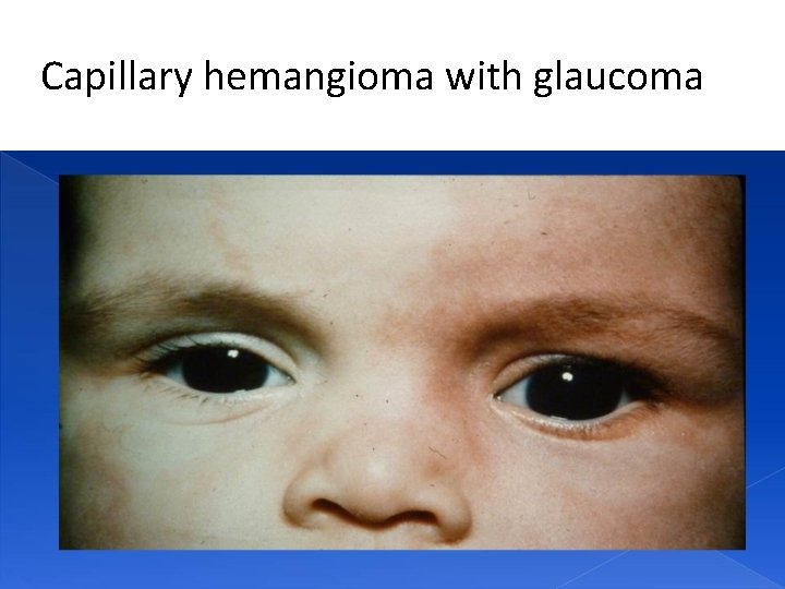 Capillary hemangioma with glaucoma 