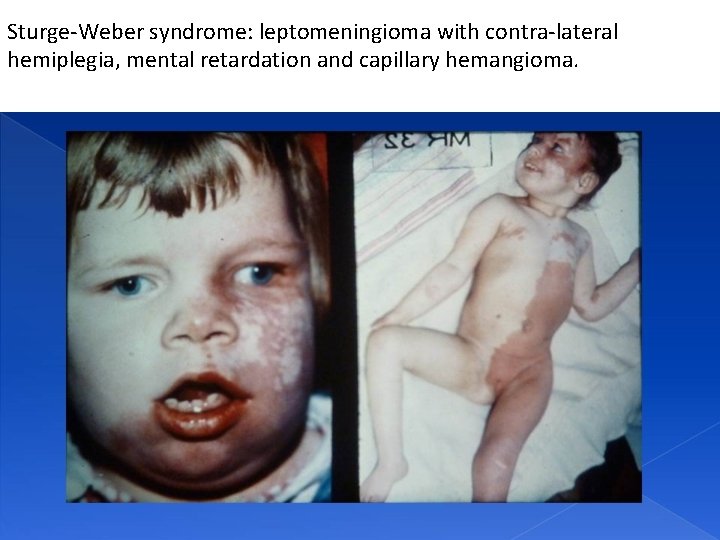 Sturge-Weber syndrome: leptomeningioma with contra-lateral hemiplegia, mental retardation and capillary hemangioma. 