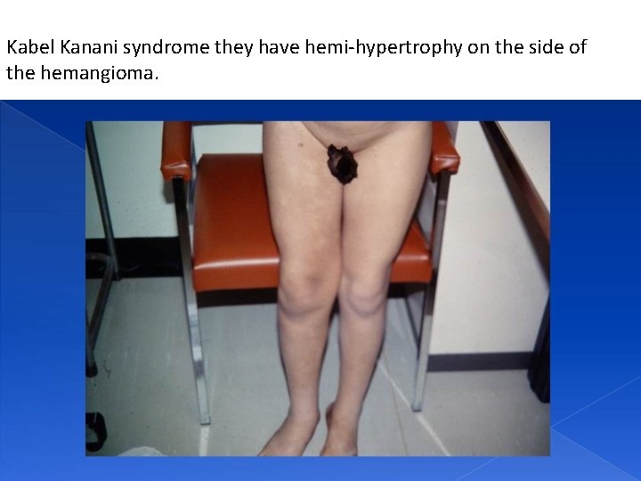 Kabel Kanani syndrome they have hemi-hypertrophy on the side of the hemangioma. 