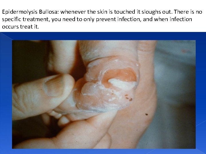 Epidermolysis Bullosa: whenever the skin is touched it sloughs out. There is no specific