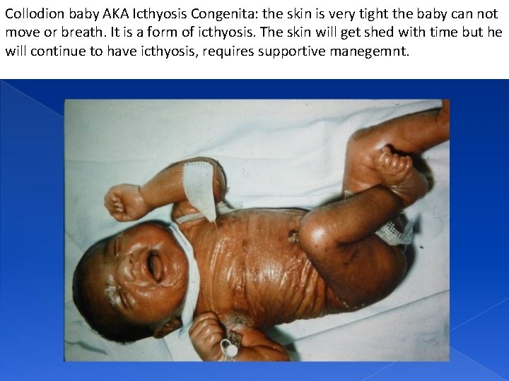 Collodion baby AKA Icthyosis Congenita: the skin is very tight the baby can not