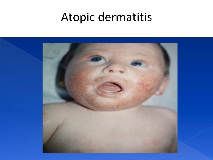 Atopic dermatitis 