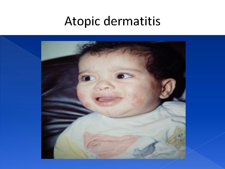 Atopic dermatitis 