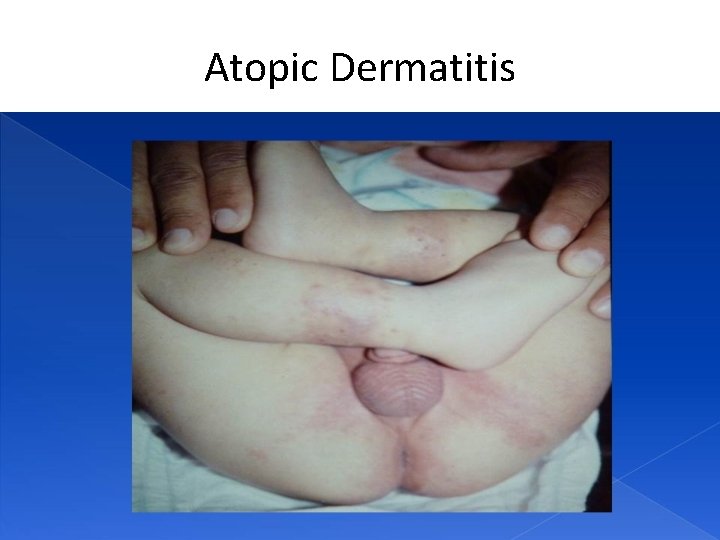 Atopic Dermatitis 