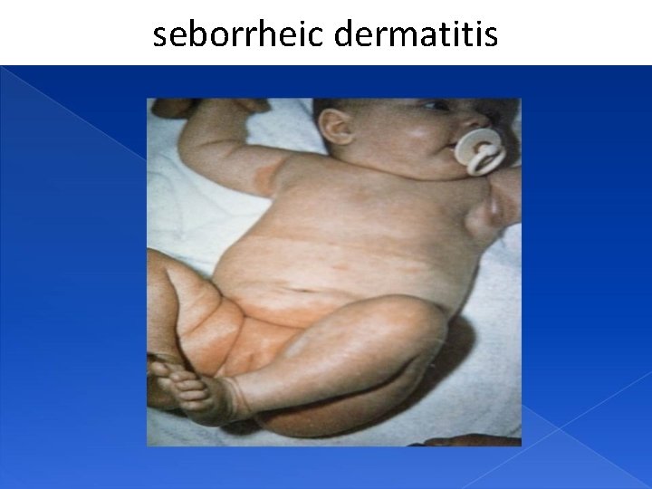 seborrheic dermatitis 