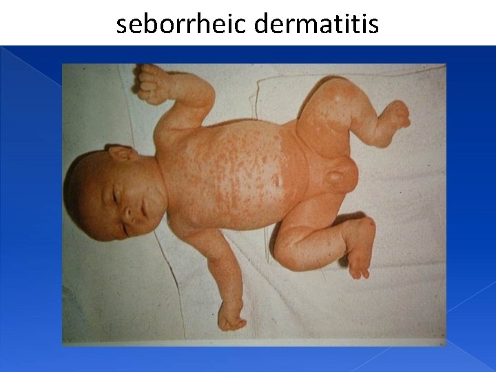 seborrheic dermatitis 