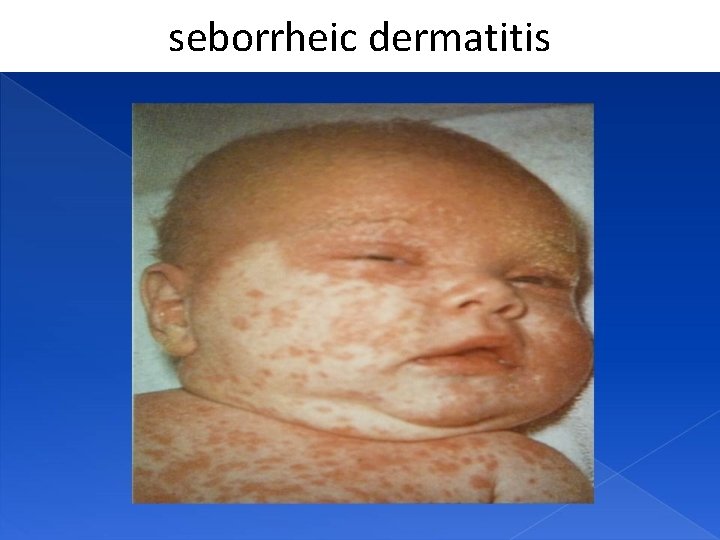 seborrheic dermatitis 