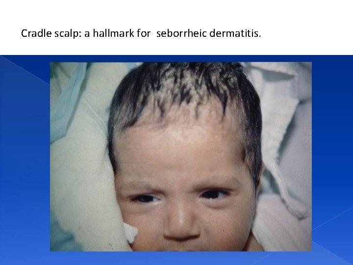 Cradle scalp: a hallmark for seborrheic dermatitis. 