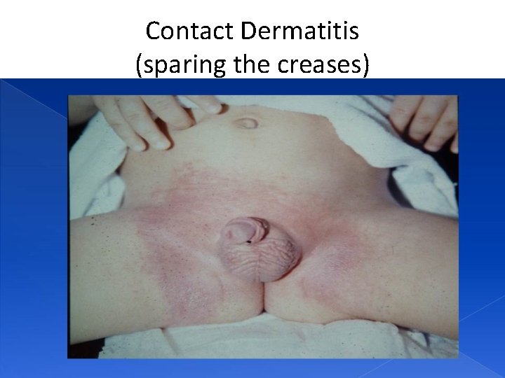 Contact Dermatitis (sparing the creases) 