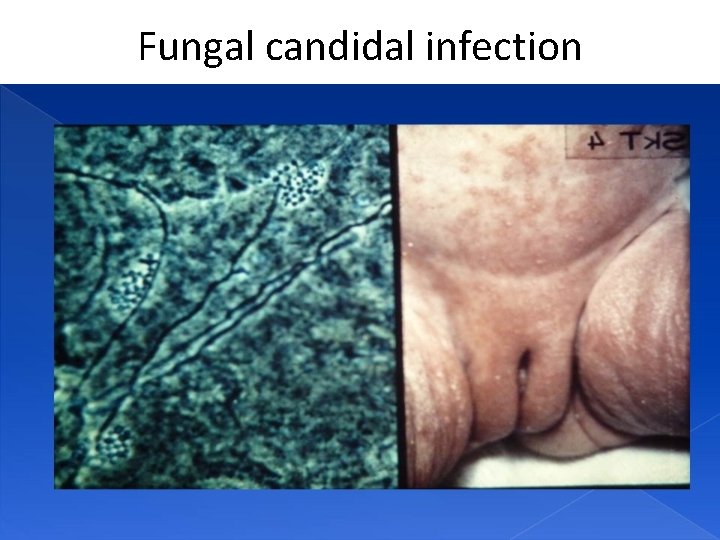 Fungal candidal infection 