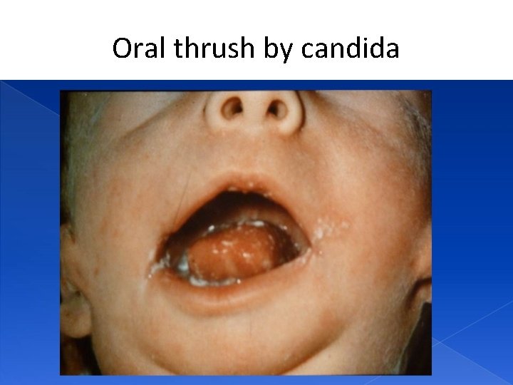 Oral thrush by candida 