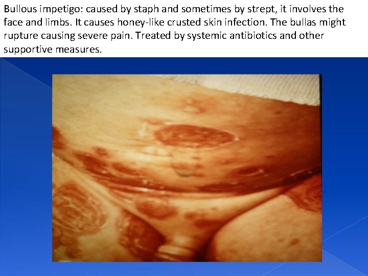 Bullous impetigo: caused by staph and sometimes by strept, it involves the face and