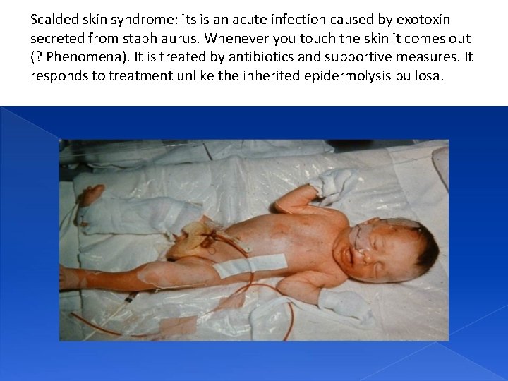Scalded skin syndrome: its is an acute infection caused by exotoxin secreted from staph