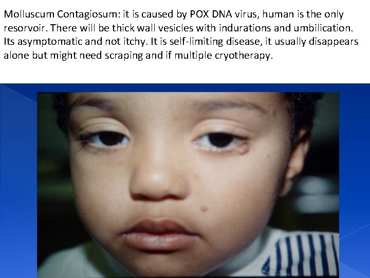 Molluscum Contagiosum: it is caused by POX DNA virus, human is the only resorvoir.