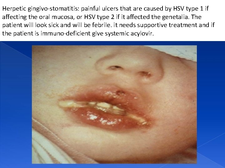 Herpetic gingivo-stomatitis: painful ulcers that are caused by HSV type 1 if affecting the