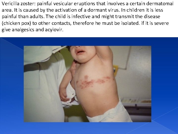 Vericilla zoster: painful vesicular eruptions that involves a certain dermatomal area. It is caused