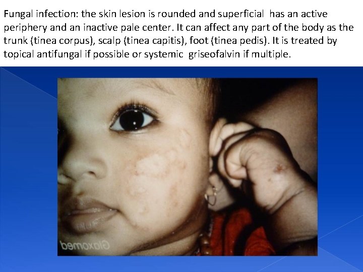 Fungal infection: the skin lesion is rounded and superficial has an active periphery and