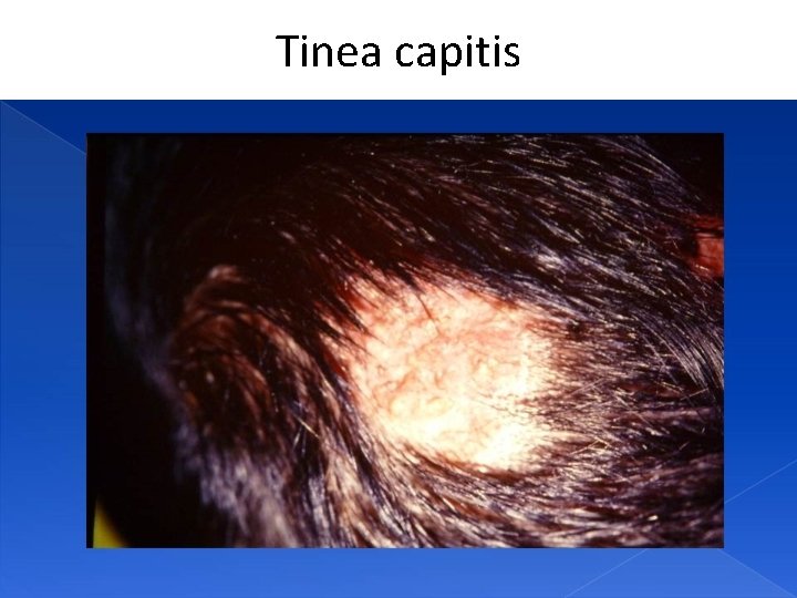 Tinea capitis 