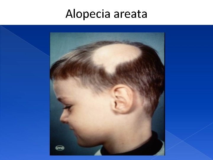 Alopecia areata 