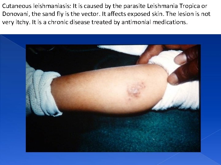 Cutaneous leishmaniasis: It is caused by the parasite Leishmania Tropica or Donovani, the sand