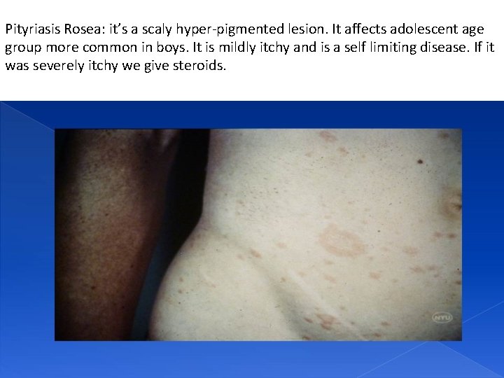 Pityriasis Rosea: it’s a scaly hyper-pigmented lesion. It affects adolescent age group more common