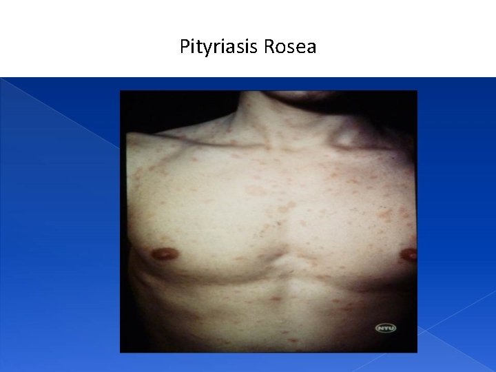 Pityriasis Rosea 