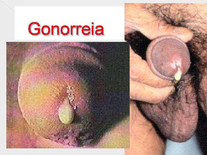 Gonorreia 