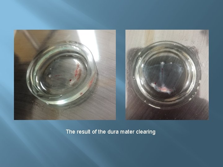The result of the dura mater clearing 