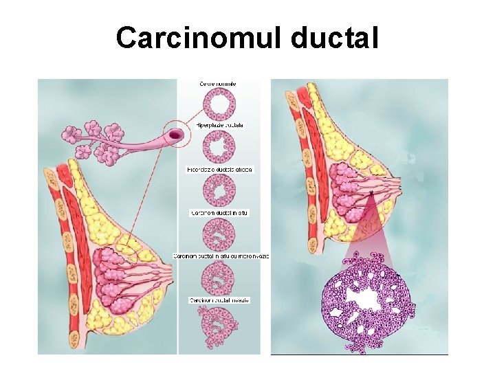 Carcinomul ductal 