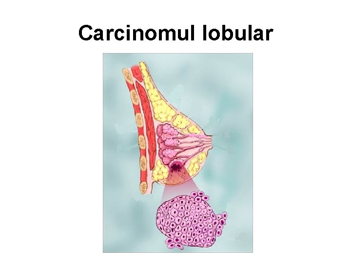 Carcinomul lobular 