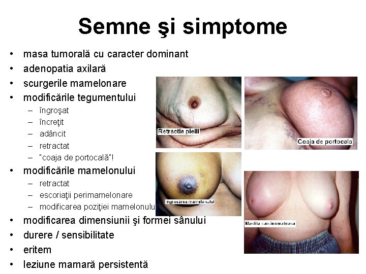 Semne şi simptome • • masa tumorală cu caracter dominant adenopatia axilară scurgerile mamelonare