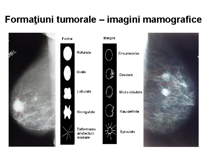 Formaţiuni tumorale – imagini mamografice 