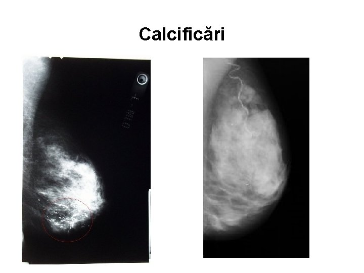 Calcificări 