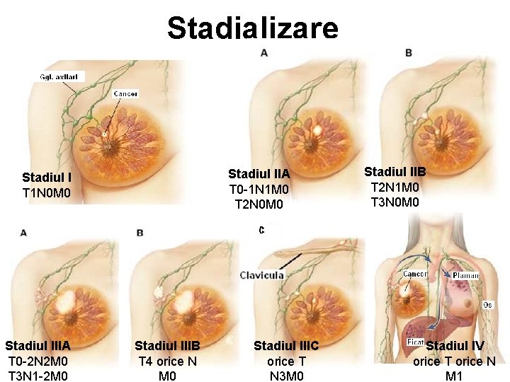 Stadializare Stadiul IIA T 0 -1 N 1 M 0 T 2 N 0