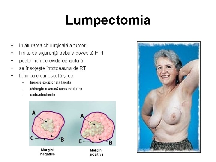 Lumpectomia • înlăturarea chirurgicală a tumorii • limita de siguranţă trebuie dovedită HP! •